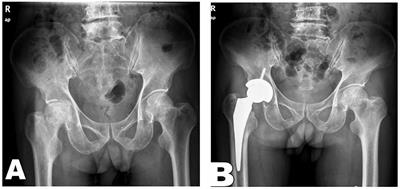 Randomized Clinical Study on the Efficacy of Direct Anterior Approach Combined With Tendon Release and Repair After Total Hip Arthroplasty